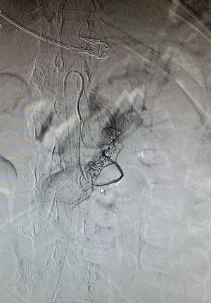 Mesenteric arteriogram with embolisation of jejunal arteries.