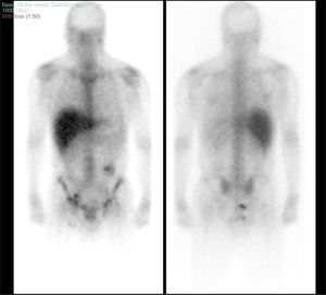 Body scan obtaining planar images in anterior and posterior projection following intravenous administration of gallium citrate-67. A pathological deposit of activity in the perianal and rectal region consistent with an inflammatory/septic condition was detected. In the left inguinal region there was a small deposit of moderate intensity suggesting reactive lymphadenopathy in that location. No other deposits were seen in the abdomen or in the rest of the body scan suggesting lymphadenopathic lesions and/or infectious conditions. There was increased activity in the region of the colostomy probably due to a physiological deposit of gallium as it was eliminated through the bowel.