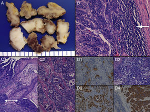 Macroscopic (A) and microscopic (B-D) characteristics of eccrine hydroadenocarcinoma. (A) Perianal resection specimen sections consisting of a whitish, homogeneous, compact tumour. (B) Microscopic image of lymph node metastasis due to hydroadenocarcinoma (see tumoural epithelial nests to the left and preserved rim of peripheral lymphoid tissue [arrow] to the right) (H&E× 400). (C) Infiltration, perianal cutaneous tumoural ulceration and lymphatic vascular invasion (double arrow) (H&E× 250) (C1), and microscopic image of the cribiform pattern of the neoplasm (H&E× 250) (C2). (D) Immunoexpression in eccrine gland lumina of carcinoembryonic antigen (CEA× 200) (D1); tumoural areas with clear-cell change (H&E× 200) (D2); intense, diffuse positivity for p53 (p53× 200) (D3); and a neoplastic component with positive immunostaining for cytokeratin 8 (CK8× 200) (D4).