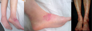 Palpable purpuric lesions on both legs and feet in patients from cases 1 (A and B) and 3 (C).