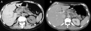 Abdominal CT scan. (A) Solid lesion with a 5cm diameter in the head of the pancreas, obstructing the duct of Wirsung, along with cysts in the pancreatic tail. (B) Cysts in the pancreatic tail.