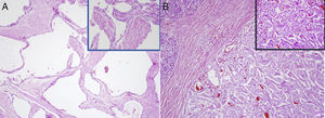 Histopathology study. (A) Serous cystadenoma: multiple cystic structures, covered by cubic or cylindrical epithelial cells, with a clear cytoplasm and a round nucleus without atypia. (B) Neuroendocrine tumour: organoid proliferation of monomorphic cells, with a mildly eosinophilic cytoplasm and regular, ovoid nucleus, with fine chromatin and low mitotic activity.