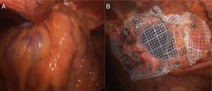 Laparoscopic surgery. (A) Incarcerated Morgagni hernia (transverse colon and omentum). (B) Hernia defect repair with polytetrafluoroethylene mesh (Omyra® Mesh).