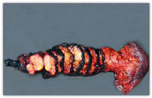Distal resection of pancreas and splenectomy. A firm whitish lesion with yellowish areas measuring 4.7cm can be seen in the body of the pancreas.