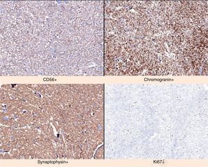 Immunohistochemical study. CD56 positive. Chromogranin positive. Synaptophysin positive. Low Ki-67.