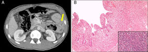(A) Abdominal CT showing the intestinal perforation in the jejunum (arrow). (B) Histological analysis of the surgically resected jejunal loop.