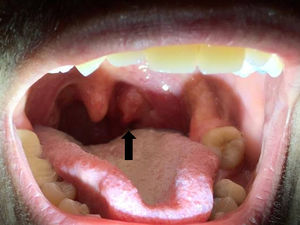 Ulcer on left tonsil with blackish, fibrinous base (arrow).