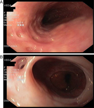 (A and B) Oesophagus with narrow areas with diverticula and mucous bridges.