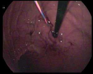 Retroflexion image of gastrostomy.