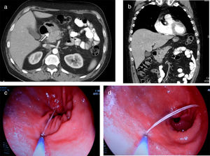 (a and b) Images from the thorax/abdomen CT scan showing frayed edges and increased peripancreatic fat density, and of the adjacent gastric antrum, pyloric region and duodenal bulb, with linear image (arrow) of at least 3cm from the lumen of the antrum to the head of pancreas, with thickening of both structures; (c and d) gastroscopy images of the extraction of the fish bone with forceps.