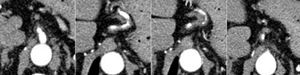 Areas of diffuse wall thickening of left gastric artery with area of multi-segmental stenosis.