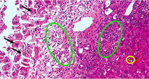 Liver biopsy with hepatitis with mixed cytolytic and cholestatic pattern. Black arrows are necrotic hepatocytes in the centrilobular region. Green circles indicate areas of cholestasis. Yellow circle indicates inflammatory infiltrate of polymorphonuclear cells (neutrophils) and eosinophils. The colours in the image can only be seen in the electronic version of the article.