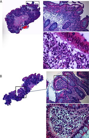 Histological showing small amastigotes structures of Leishmania spp, in the right colon mucosa (A) and in the terminal ileum (B).