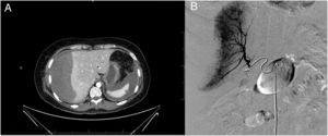 (A) CT: image showing subcapsular hepatic haematoma measuring 100×120×190mm. (B) Arteriogram: treatment by vascular embolisation.