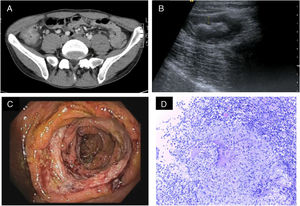 Ileocolitis with wall thickening seen by CT (A) and ultrasound (B). Endoscopic view of ascending colon with oedematous and ulcerated mucosa (C). Histology of a colon sample showing a caseating granuloma (D).