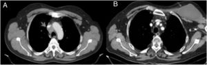 Chest CT images. (A) On the left, the arrow is pointing to a block of lymphadenopathy surrounding the superior vena cava. (B) On the right, a cervical-thoracic cystic tumour is clearly visible (arrow).