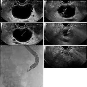 (a) Identification and characterisation of the lesion. (b) An EUS-guided needle for puncture is inserted. (c) Fluoroscopic control of the procedure. (d) Aspiration and injection 80–90% alcohol until full. (e) Complete aspiration of the ethanol volume injected. (f) Complete collapse of the cystic lesion.
