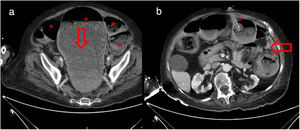 Urgent abdominal CT. (a) Distension of the colon with abundant stools (asterisks) and faecaloma in sigmoid colon/rectum (arrow). (b) PEG balloon tube located in lumen of colonic (asterisk) and fistulous tract 17mm long between gastric wall and colon (arrow).