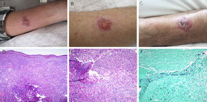 (A) Pyoderma gangrenosum in the left forearm at diagnosis. (B) Ulcerated lesion on the right forearm with growth of C. neoformans in culture. (C) Cutaneous cryptococcosis on the right forearm, after antifungal treatment. (D) Haematoxylin–eosin stain 10×. (E) PAS staining 20×. (F) Grocott-Gomori stain 20×.