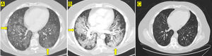 Chest CT scan. Radiological images of interstitial lung disease.
