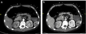 Findings in vascular CT of the aorta consistent with infarcts in the right kidney and an infarct in the inferior pole of the spleen. (a) In arterial phase, (b) in venous phase.