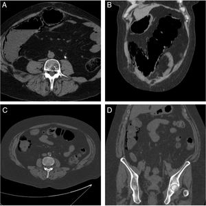 Case 1: axial (A) and coronal (B) slices from the abdominal and pelvic CT scan without contrast medium in which extensive pneumatosis intestinalis is observed in the ascending and transverse colon. Case 2: axial (C) and coronal (D) slices from the abdominal and pelvic CT scan without contrast medium in which pneumatosis intestinalis limited to the ascending colon is observed.