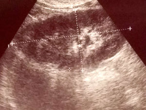 Ultrasonography imaging shows a hypoechoic 14mm mass.