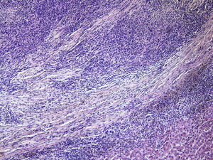 Microscopic view of IgG4-related hepatitis. The hepatic stroma shows extensive fibrosis and abundant inflammatory infiltrate.