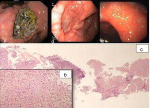 a) UGIE showing giant ulceration with irregular edges, in the lesser curvature; b) Gastric biopsy samples showing necrotic debris, mild active atrophic chronic gastritis and a fragment of hepatic tissue with active chronic inflammatory process, H&E, 20x; c) H&E, 400x. d) Second UGIE (15 days latter) showing ulcer healing; e) UGIE (2 years latter) showing complete healing of gastric mucosa.