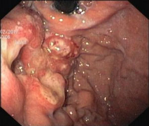 Upper digestive endoscopy: on the gastric side of the cardia, an irregular, friable and ulcerated vegetative lesion occupying one-third of the circumference of the lumen.