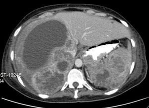 CT scan: liver enlargement with several solid lesions in both lobes, with a necrotic aspect, the largest with at least 16cm of the largest axis, with a cystic component; spleen with numerous solid lesions; thickened and irregular gastric fundus wall.