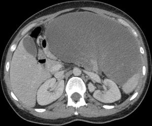 CT scan: heterogeneous retroperitoneal mass, which displaces and compresses structures.