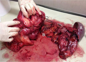 Surgical specimen. Marked as (A) spleen, (B) tail of the pancreas, (C) tumour mass.