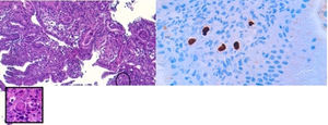 (A and B) Associated changes at the border of the ulcer, with marked foveolar hyperplasia, reactive epithelial abnormalities and chronic and acute non-specific inflammation. Focally, large stromal or endothelial cells with nuclear and cytoplasmic inclusions characteristic of CMV infection can be seen.