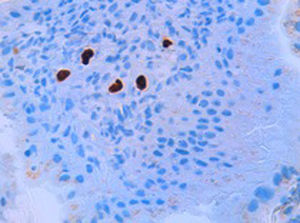 Immunohistochemical staining for CMV confirms the diagnosis and highlights a large number of cells with vital inclusions.