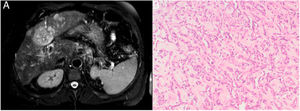 (A) MRI showing nonspecific hepatic nodules. (B) Diffuse infiltration by a vascular malignancy with a high degree of atypia and cellular pleomorphism (hematoxylin–eosin).