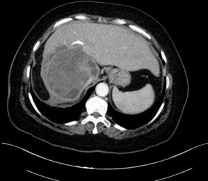 CT scan of abdomen and pelvis, axial slice: complicated hydatid cyst in liver segments VI, VII and VIII.