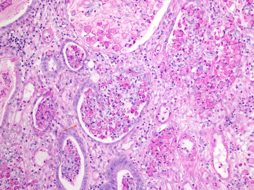Stomach Tissue Slides (Signet Ring Cell Carcinoma)- Paraffin (NBP2-77934):  Novus Biologicals