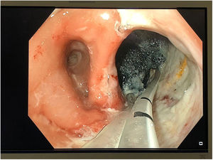 Placement of Endo-Sponge® system with endoscopic view.
