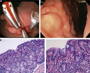 A. Endoscopic findings with gatric ulcus treated with hemostatic clips and nodular pattern of the stomach. B. Pathological findings showing diffusely infiltrated eosinophils (H&E stain, 20×; H&E stain, 40×).