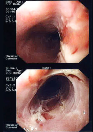 Upper gastrointestinal endoscopy. Mucosa in the entire oesophagus with widespread superficial ulceration, forming an erythematous and very friable base.