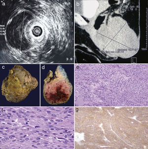 (a) Endoanal ultrasound with hypoechoic lesion attached to the rectal wall, (b) sagittal plane CT scan, a neoplastic lesion in the anorectal region is identified, (c) external macroscopic appearance, (d) macroscopic appearance upon section, (e) a neoplastic lesion composed of irregular and intertwined cell bundles is observed (haematoxylin and eosin, 10×), (f) the neoplastic cells are tapered with ovoid nuclei, note atypical mitoses, and (g) positive immunoreaction for CD117 in the neoplastic cells.