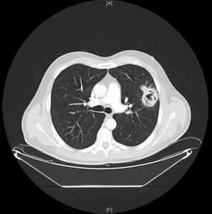 Lung CT scan.