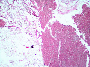 (H&E, ×40) Cyst contents comprising sheets of flaky keratin and masses of shadow cells.
