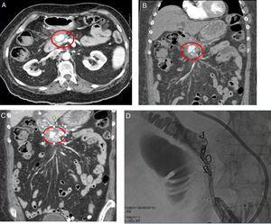 (A) Axial section showing the pseudoaneurysm (circle) and its anatomical relationships. (B and C) Coronal sections showing the pseudoaneurysm (circle) and its impression on the bile duct. (D) Implantation of the coils for embolisation.