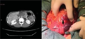 Duodenal haematoma as seen in the CT (A) and during surgery (B).