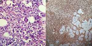 (A) Magnification (×40) of the haematoxylin and eosin stain of neoplastic cells with rhabdoid phenotype: marked pleomorphism and visible nucleoli, frequent mitotic figures, large eosinophilic cytoplasms. (B) Staining with vimentin (×20), positive in the mesenchymal component with rhabdoid phenotype and negative in the more differentiated epithelial component (adenocarcinoma).