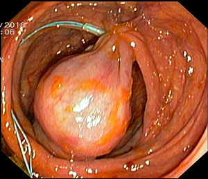 Endoscopic image of the polypoid lesion, with an endoloop placed around the stalk.