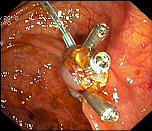 Endoscopic image of the endoloop and the hemostatic clips ensuring good hemostasis.