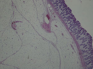 Histopathology showing mature adipocytes at the submucosal layer, in relation to a lipoma; 40×.